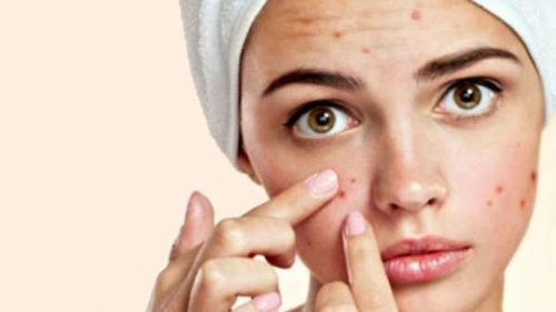 Photo of Know how to get rid of acne in minutes