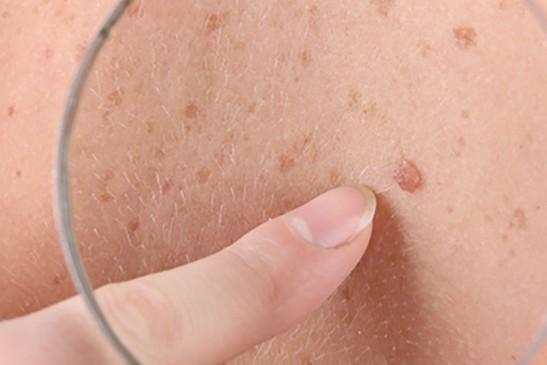 صورة سرطان الجلد.. الأعراض والأسباب ونصائح وقائية وعلاجية